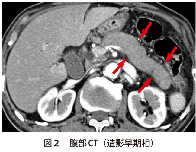 図2　腹部CT（造影早期相）