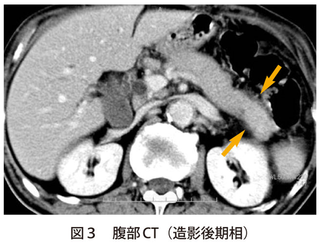 図3　腹部CT（造影後期相）