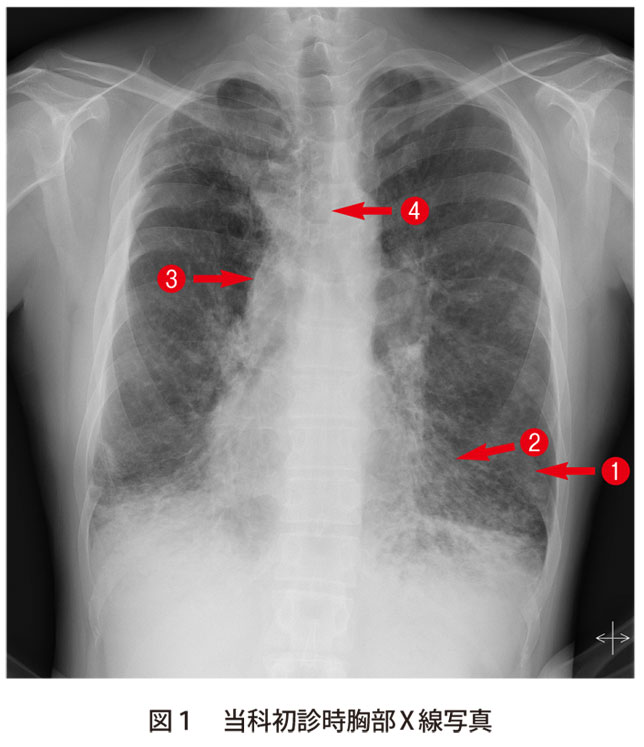 図1　当科初診時胸部X線写真