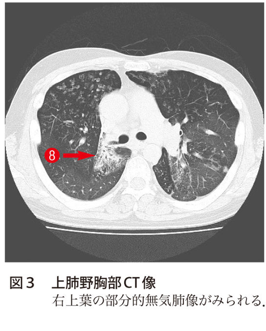 図3　上肺野胸部CT像