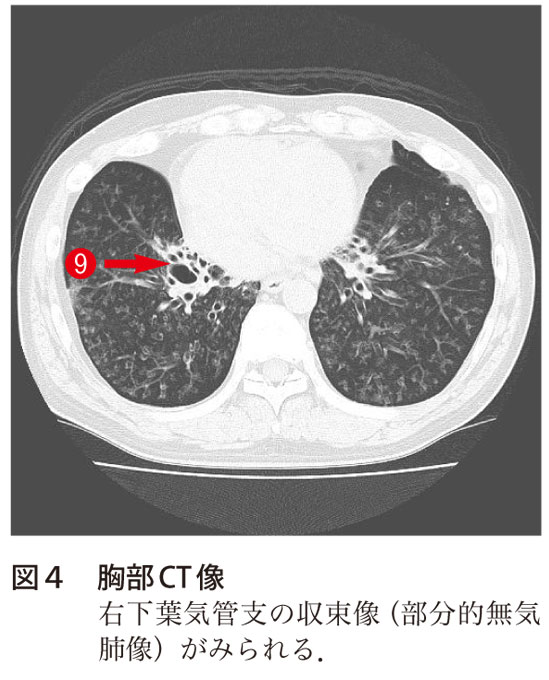 図4　胸部CT像