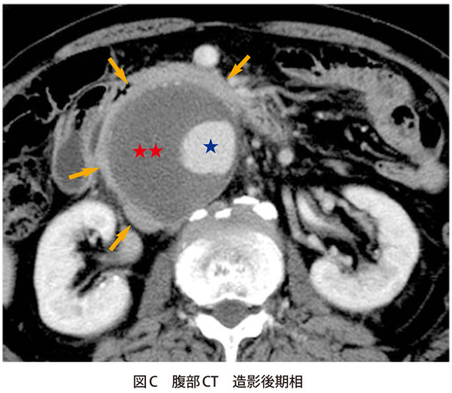 図C　腹部CT　造影後期相