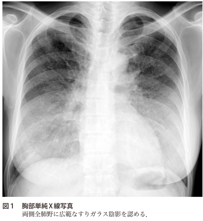 解答 解説 3週間前からの発熱 咳嗽 呼吸困難で受診した40歳代男性 実践 画像診断q A 羊土社 レジデントノート 実践 画像診断q A 羊土社 レジデントノート 羊土社