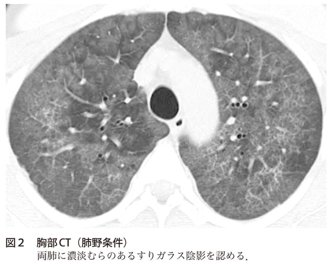 解答 解説 3週間前からの発熱 咳嗽 呼吸困難で受診した40歳代男性 実践 画像診断q A 羊土社 レジデントノート 実践 画像診断q A 羊土社 レジデントノート 羊土社