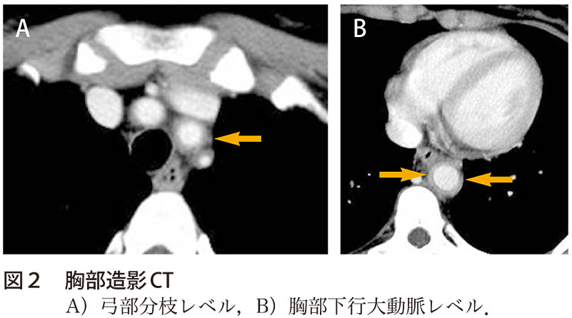 図2　胸部造影CT／A）弓部分枝レベル，B）胸部下行大動脈レベル．