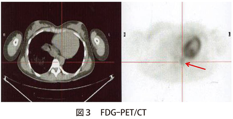 図3　FDG-PET/CT