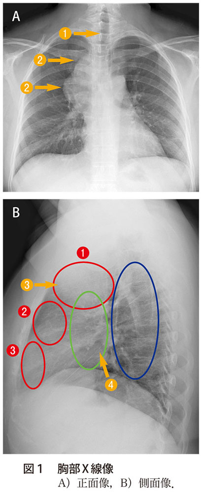 図1　胸部X 線像　A）正面像，B）側面像
