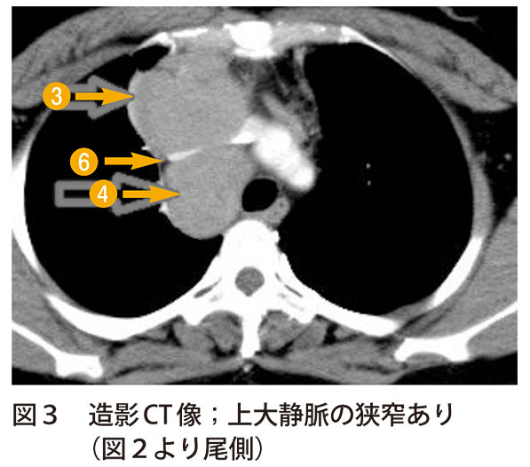 図3　造影CT 像；上大静脈の狭窄あり（図2より尾側）