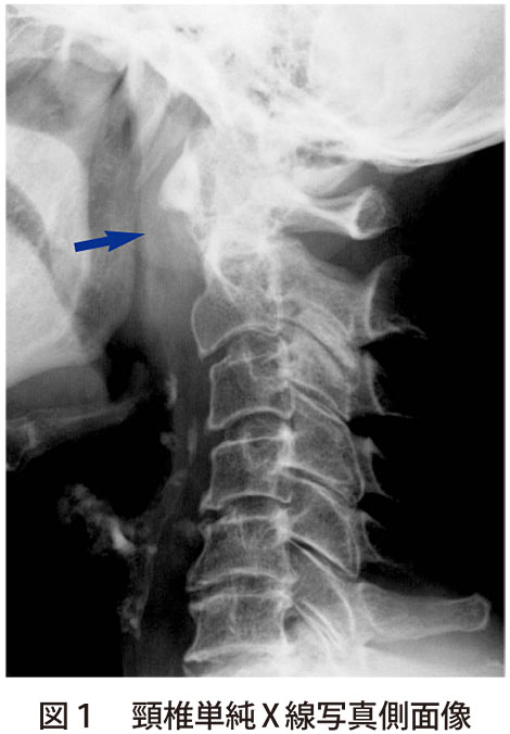 図1　頸椎単純X線写真側面像