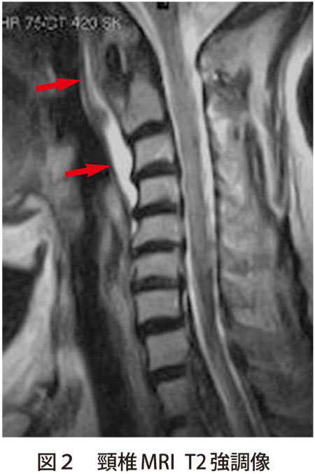 図2　頸椎MRI T2強調像