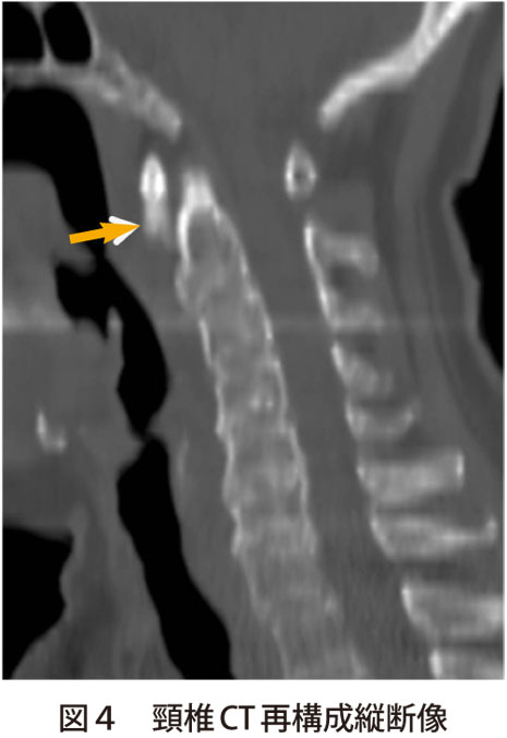 図4　頸椎CT再構成縦断像