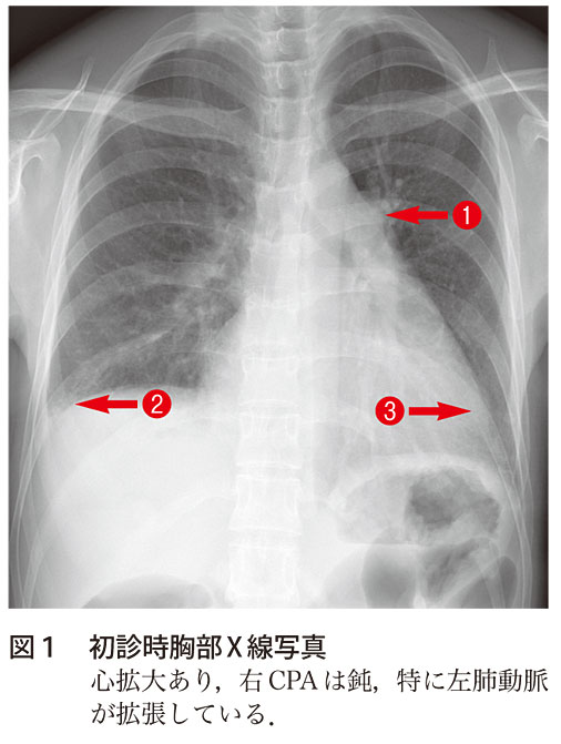 図1　初診時胸部X線写真