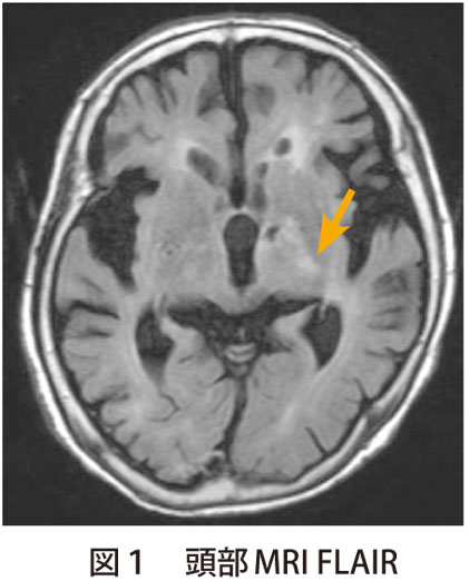図1　頭部MRI FLAIR