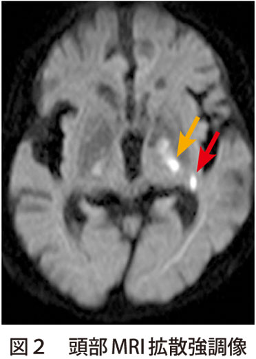 図2　頭部MRI拡散強調像