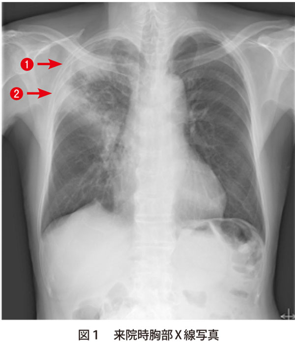 図1　来院時胸部X線写真