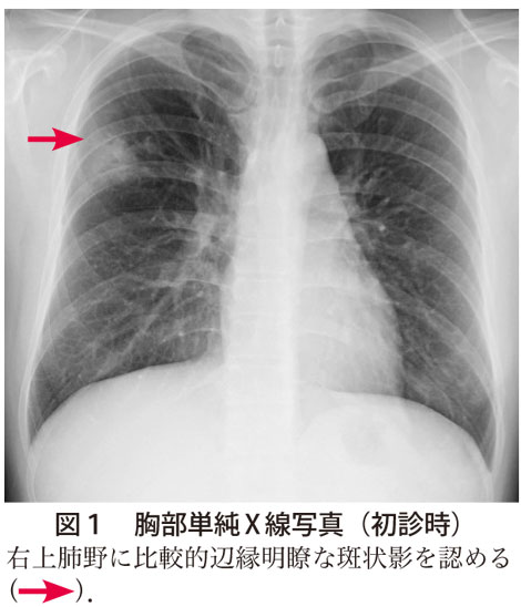 図1　胸部単純X 線写真（初診時）