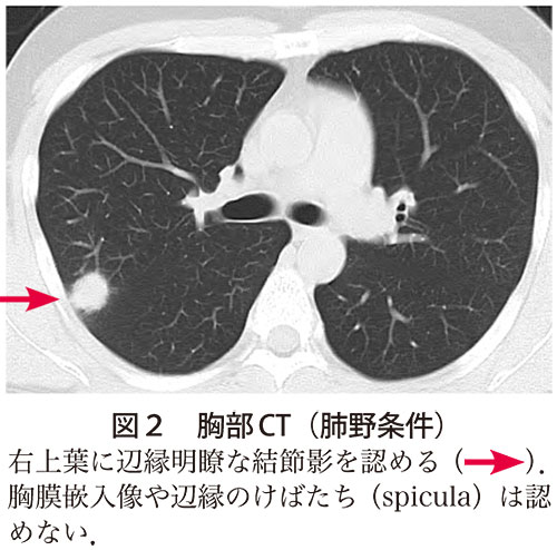 図2　胸部CT（肺野条件）