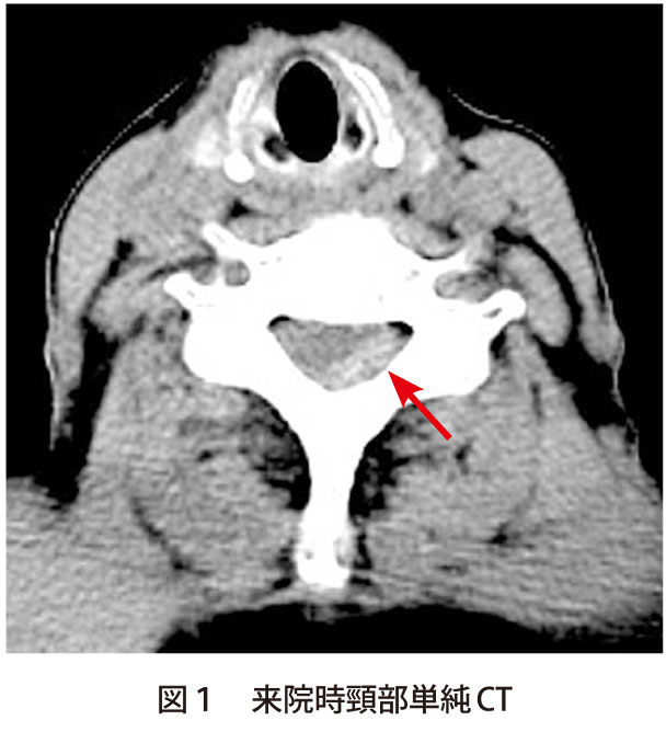 図1　来院時頸部単純CT