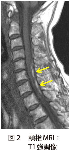 図2　頸椎MRI：T1 強調像