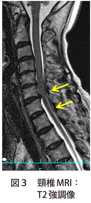 図3　頸椎MRI：T2 強調像