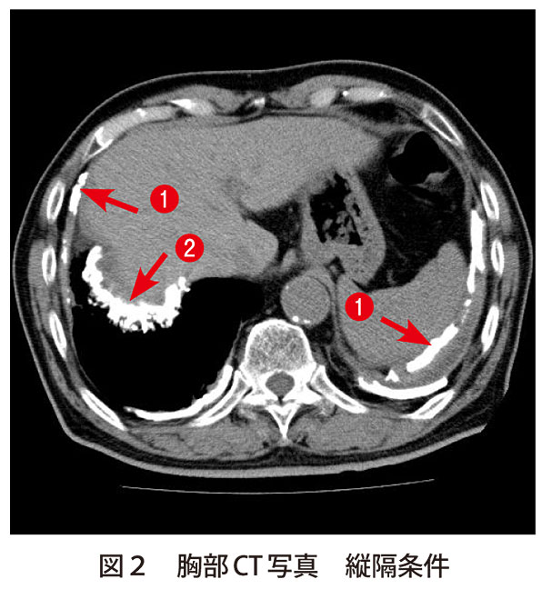 図2　胸部CT 写真　縦隔条件