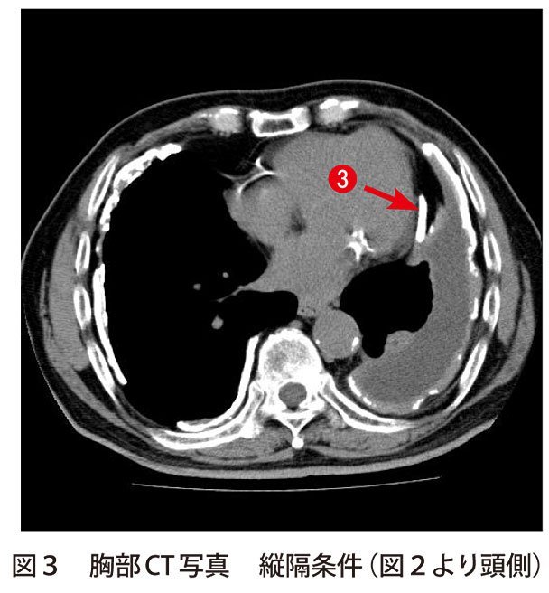 図3　胸部CT写真　縦隔条件（図2より頭側）