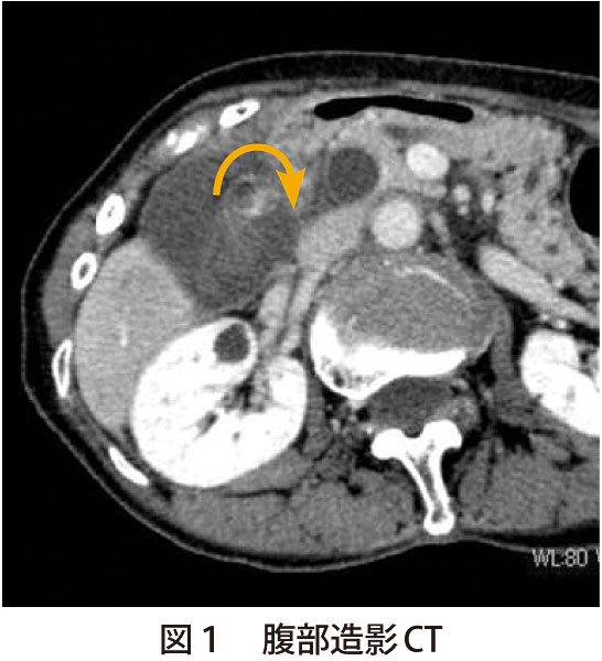 図1　腹部造影CT