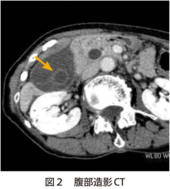 図2　腹部造影CT
