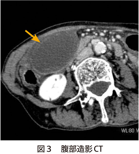図3　腹部造影CT