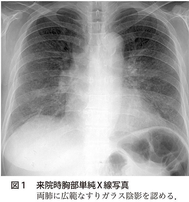 図1　来院時胸部単純X線写真
