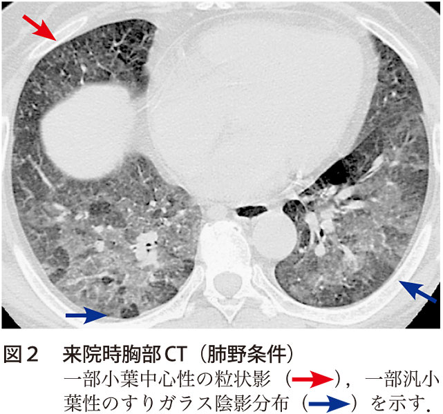 図2　来院時胸部CT（肺野条件）