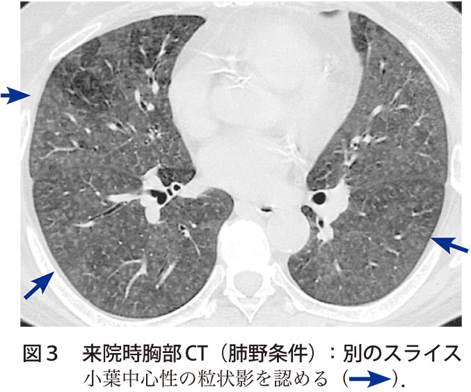 図3　来院時胸部CT（肺野条件）：別のスライス