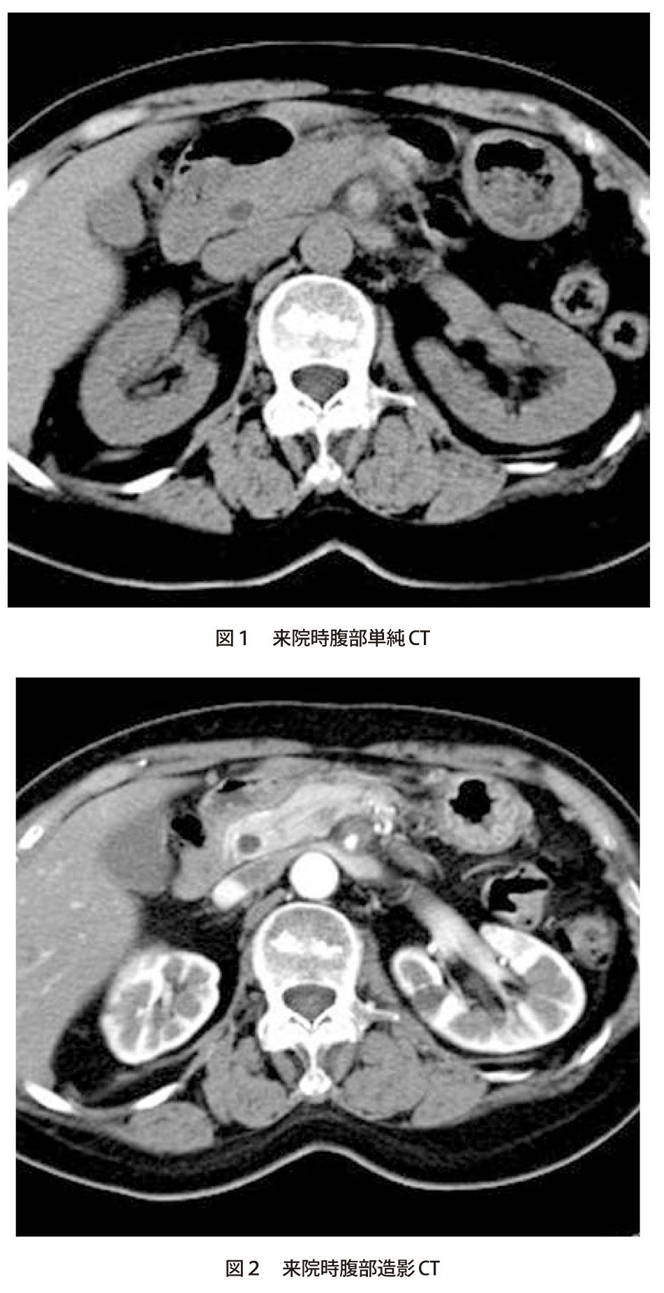 問題】血管性病変が原因である急性腹症の1つです｜実践！画像診断Q&A｜羊土社：レジデントノート ｜実践！画像診断Q&A｜羊土社：レジデントノート -  羊土社