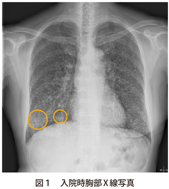 図1　入院時胸部X線写真