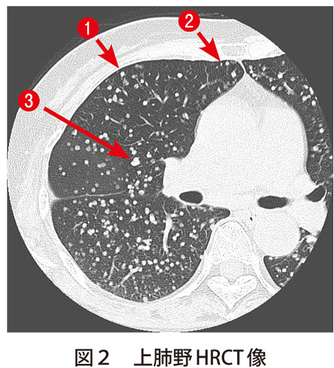図2　上肺野HRCT像