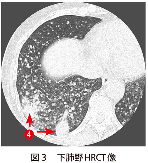 図3　下肺野HRCT像