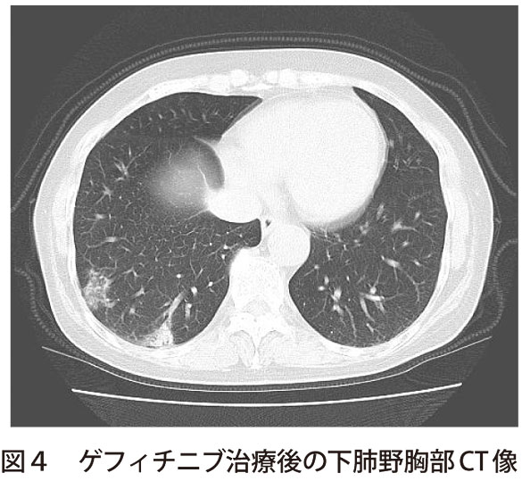 図4　ゲフィチニブ治療後の下肺野胸部CT像