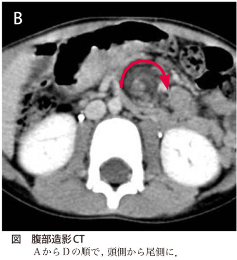 レジデントノート 2013年2月号掲載【解答・解説】腸回転異常症の合併症の1つです