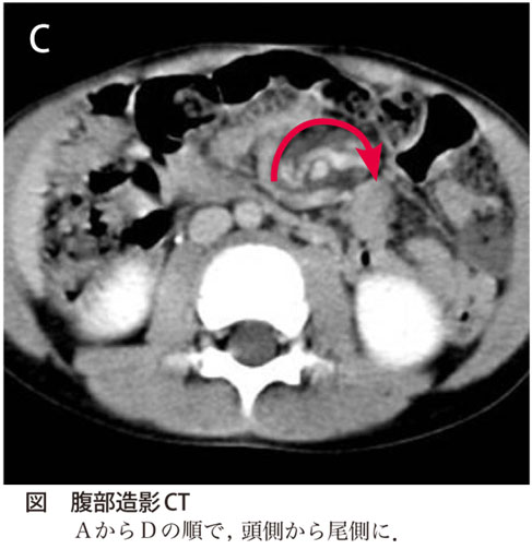 図C　腹部造影CT　A からD の順で，頭側から尾側に．