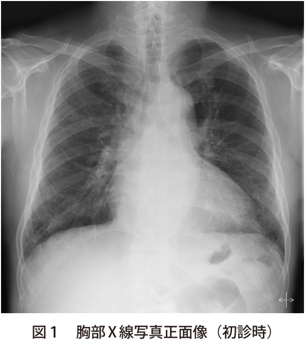 図1　胸部X 線写真正面像（初診時）