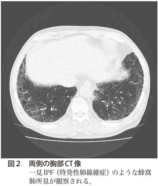 図2　両側の胸部CT 像