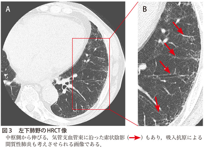 図3　左下肺野のHRCT 像