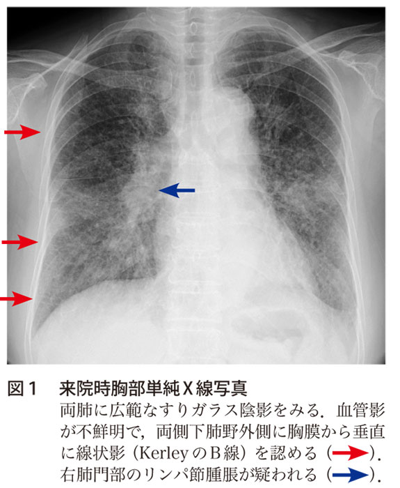 図1　来院時胸部単純X線写真
