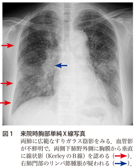 解答 解説 食欲不振 乾性咳嗽 呼吸困難で受診した70歳代女性 実践 画像診断q A 羊土社 レジデントノート 実践 画像診断q A 羊土社 レジデントノート 羊土社