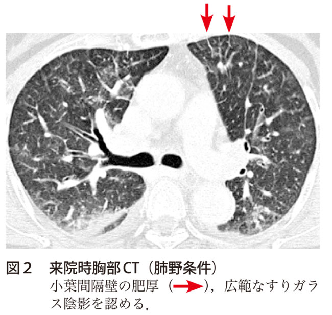 図2　来院時胸部CT（肺野条件）