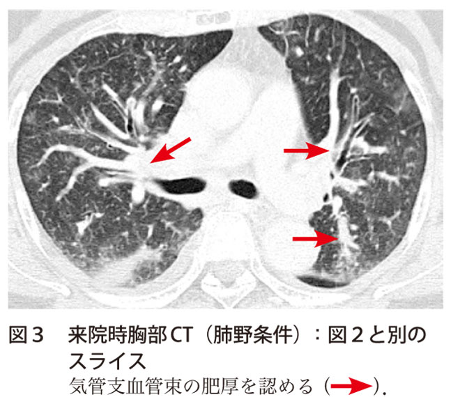 図3　来院時胸部CT（肺野条件）：図2と別のスライス