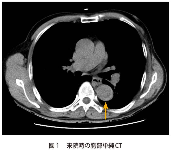 図1　来院時の胸部単純CT