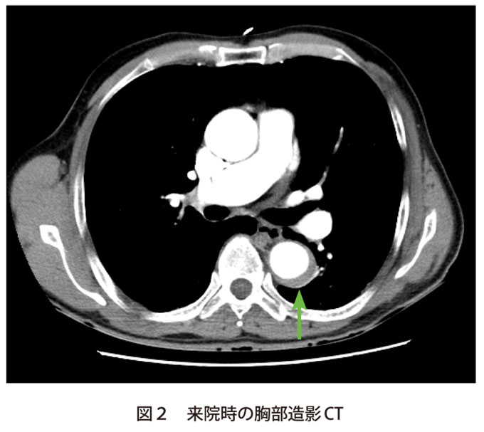 図2　来院時の胸部造影CT