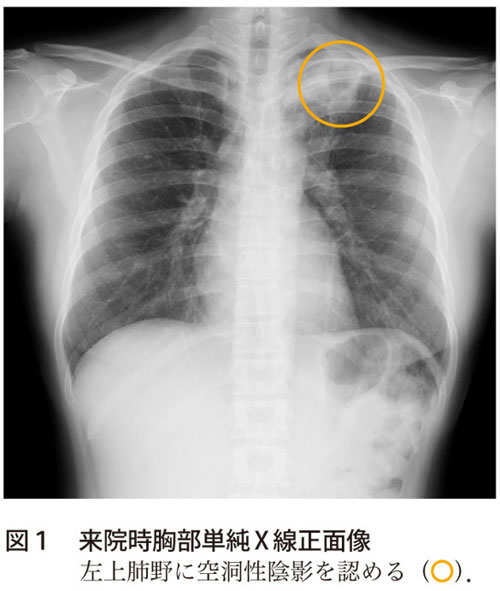 図1　来院時胸部単純X線正面像