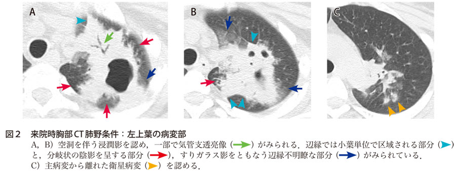図2　来院時胸部CT肺野条件：左上葉の病変部